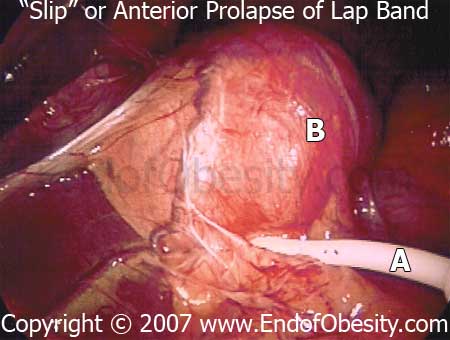 End of Obesity - Images and Pictures of Lap Bands, Lap Band Problems, 